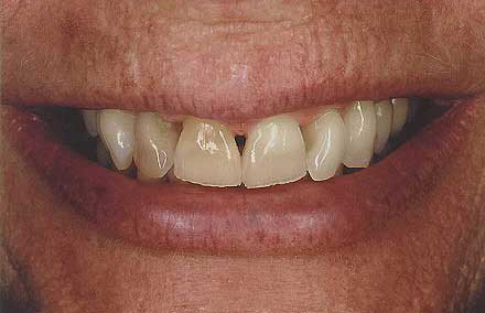 Smile with receding gums revealing tooth roots