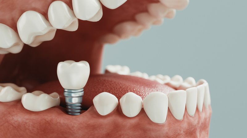 Dental implant post being placed in mouth