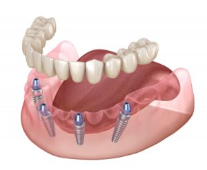 diagram of implant dentures