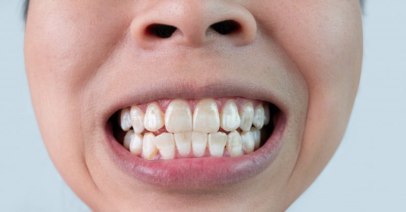 Close-up of types of tooth stains