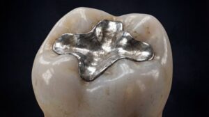 Metal tooth filling. 
