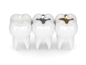 different types of dental fillings
